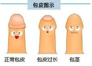 包皮垢有哪些危害呢?